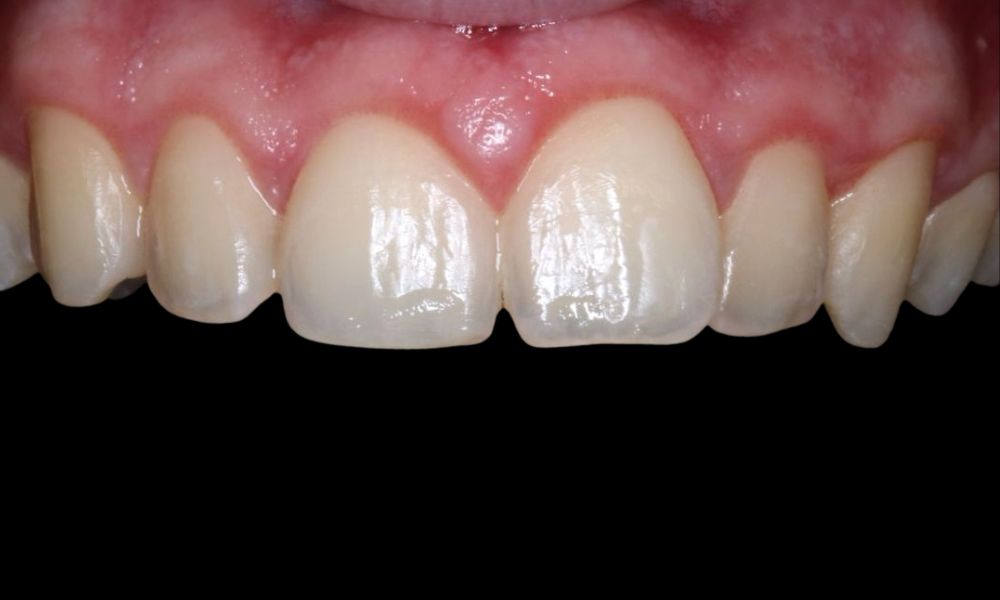 antes - clareamento dental